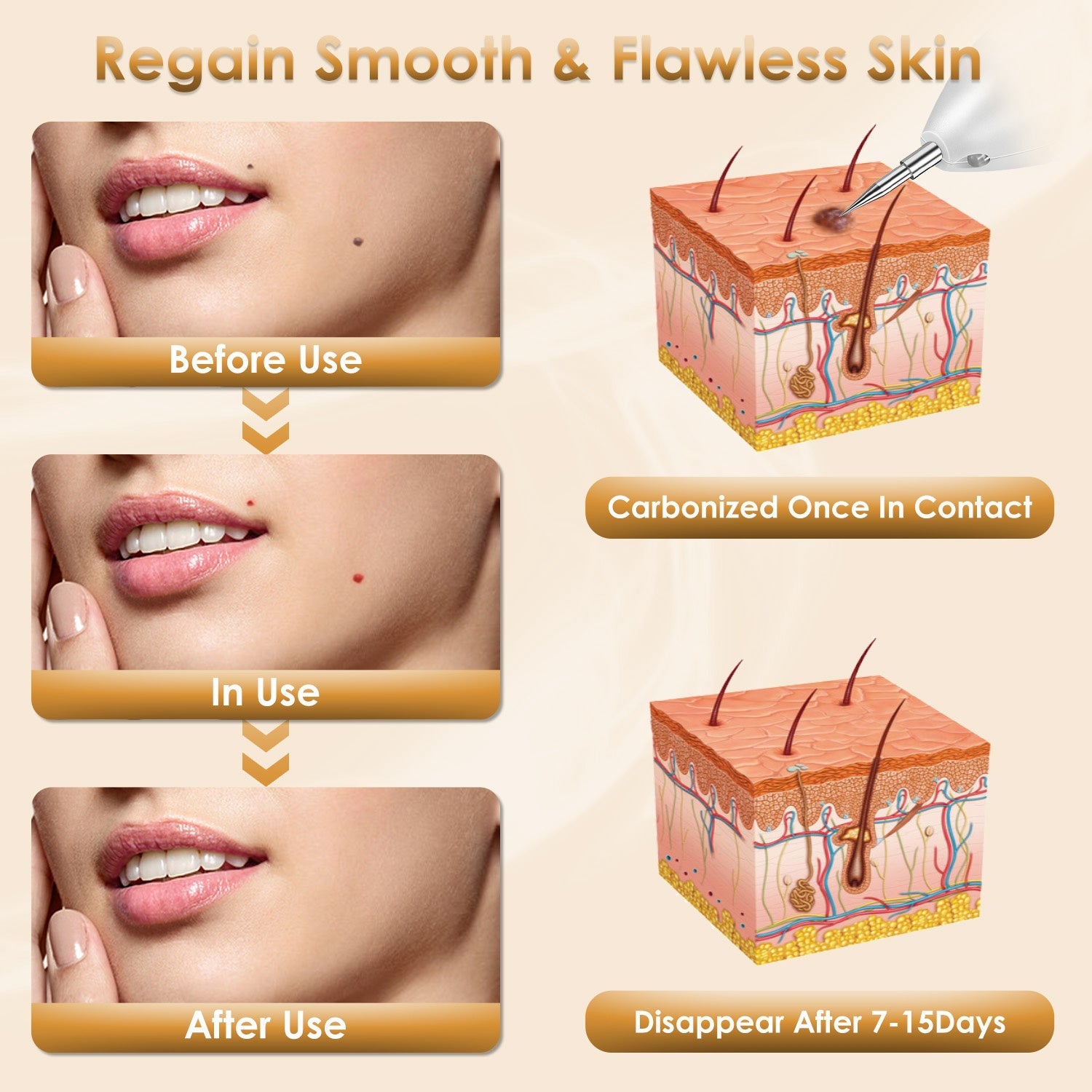 Rechargeable Mole & Wart Remover