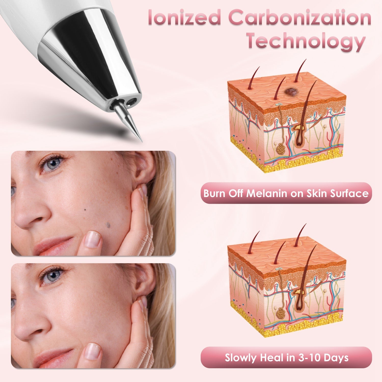 Wart & Freckle Remover with Needles