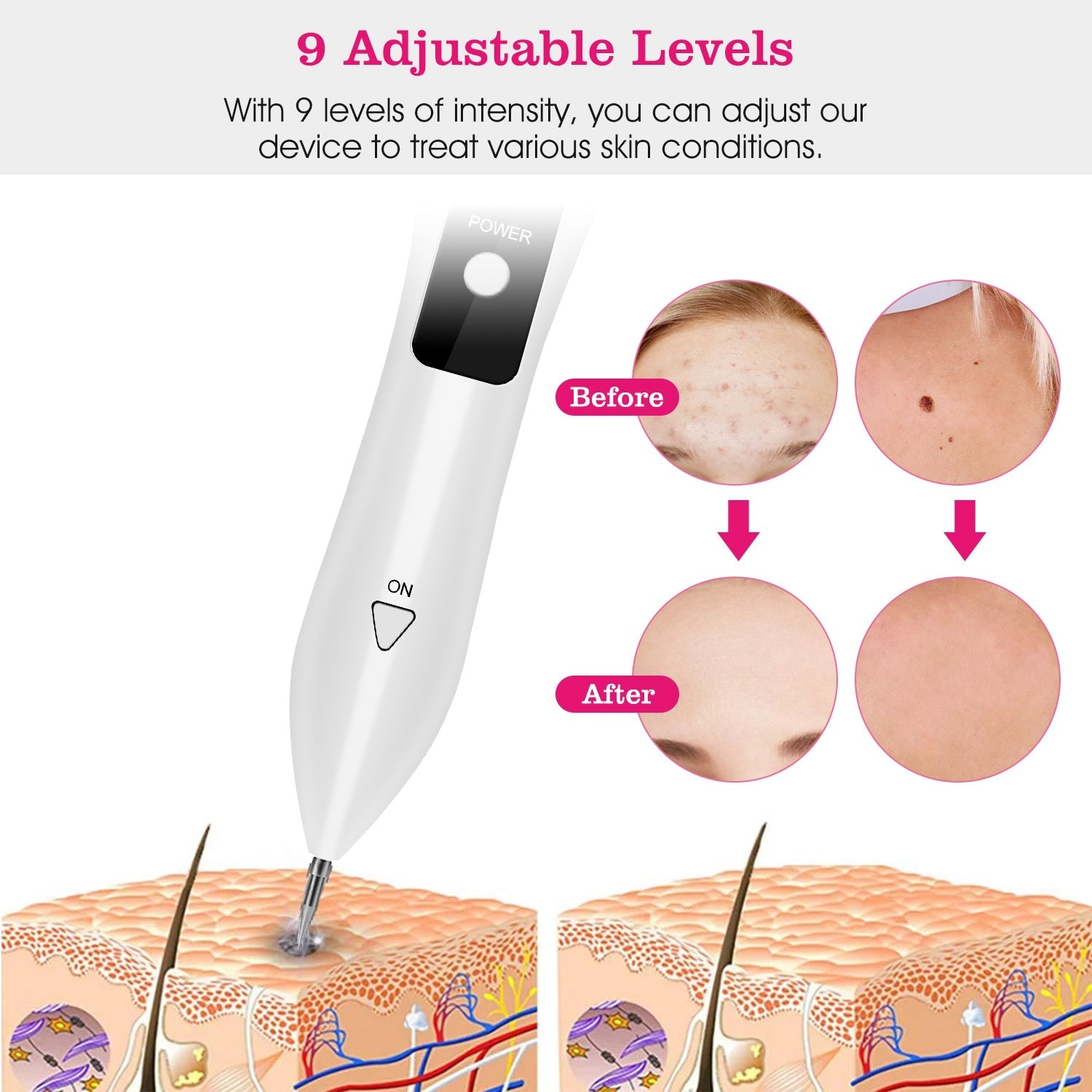 Portable Skin Tag & Blemish Remover